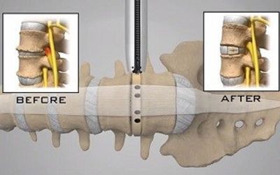 Extreme Lumbar Interbody Fusion and Direct Lateral Lumbar Interbody Fusion