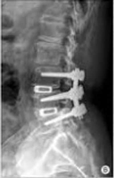 Combined Anterior Lumbar Interbody and Posterolateral Fusion