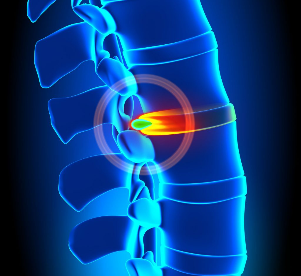 Example of herniated disc